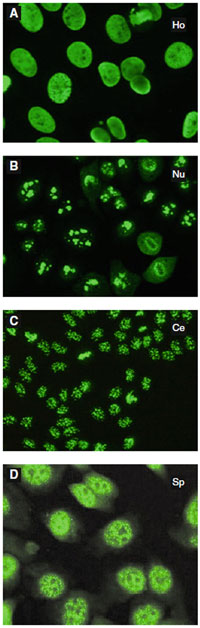 Figure 3.31 ANA patterns A: Homogenous* B: Nucleolar* C: Centromeric* *Reprint from Cuenca S, et al. Rationelle und rationale Laboratorium diagnostik in der Hals-Nasen-Ohren-Heilkunde. HNO. 2008: 56 (9); 855–73 D: Speckled (Reprint from Vergani D, et al. Autoimmune Hepatitis. Seminars in Immunopathology. 2009: 31 (3); 421–435)