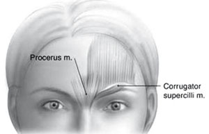 Fig. 5.3. Illustration of upper facial muscles involved in the expression of frowning