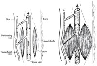 Fig. 8.1a,b. Schematic diagram of the calf-muscle pump. a Relaxed state: all valves are open allowing blood to flow in a proximal direction. Blood flows proximal in both the superficial vein and through the perforating vein into the deep veins. bWith muscle contraction, the perforating veins are squeezed closed. Valves distal to the compression are closed to prevent distal blood flow. (Reprinted with permission from Goldman MP (1991) Sclerotherapy: Treatment of varicose and telangiectatic leg veins. Mosby, St. Louis.)