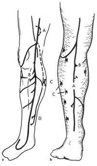 Fig. 8.3. a Typical course of the long saphenous vein (LSV), including its common tributaries and perforating veins. A Hunterian perforating vein, B posterior tibial perforating vein, C calf perforator in the location of the intrasaphenous vein,D medial ankle, or Cockett perforators. b Typical course of the SSV with termination above the popliteal fossae and associated perforator veins. A SSV, B intersaphenous vein with calf perforator, C paraperoneal perforating veins. (Reprinted with permission from Goldman MP (1991) Sclerotherapy: Treatment of varicose and telangiectatic leg veins. Mosby, St. Louis.)