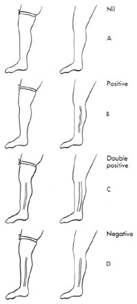 Fig. 8.4A–D. Interpreting the Brodie-Trendelenburg test. A Nil: no distention of the veins for 30 s both while the tourniquet remains on and also after it is removed implies a lack of reflux. B Positive: distention of the veins only after the tourniquet is released implies reflux only through the saphenofemoral junction (SFJ). C Double positive: distention of the veins while the tourniquet remains on and further distention after it is removed implies reflux through perforating veins as well as the SFJ. D Negative: distention of the veins while the tourniquet remains on and no additional distention once it is removed implies reflux only through perforating veins. (Reprinted with permission from Goldman MP (1991) Sclerotherapy: Treatment of varicose and telangiectatic leg veins. Mosby, St. Louis.)