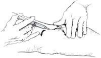 Fig. 8.6. Illustration of proper hand placement to exert three-point traction to aide in needle insertion. Injection is made into the feeding “arm” of the “fingers” of the spider vein. (Reprinted with permission from Goldman MP (1991) Sclerotherapy: Treatment of varicose and telangiectatic leg veins. Mosby, St. Louis.)