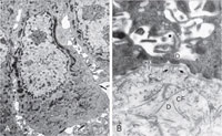 A, Keratinocyte. An electron micrograph illustrates the ultrastructural components of a typical keratinocyte in the stratum spinosum, including the nucleus (N), tonofilaments (T), and desmosomal intercellular connections (arrow) that give this layer its 'spiny' appearance. B, Basement membrane zone (BMZ). At the interface of the basal keratinocytes (K) of the epidermis and dermis (D) is the BMZ. The keratinocytes are attached to the BMZ by hemidesmosomes (HD). The BMZ is composed of the lamina lucida, which is the upper clear area, and the lamina densa, which is the dark area just below the lamina lucida. Anchoring fibrils (arrows) bind the BMZ to the dermis by intercalating among the collagen fibers (CF) of the dermis.