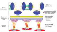 This diagram of the dermal epidermal junction illustrates the affected levels in the various types of epidermolysis bullosa (EB).