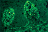 Direct immunofluorescence of skin demonstrating linear granular IgA along the basement membrane zone and in the papillary dermis in a patient with dermatitis herpetiformis.  (Courtesy of the Fitzsimons Army Medical Center teaching files.)