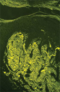 Lichen amyloidosis. Thioflavin-T demonstrates strong staining of fluorescent amyloid in the papillary dermis. (Courtesy of James E. Fitzpatrick, MD.)