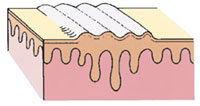 Lichenification.