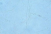 Refractile and cylindrical hyphae traversing KOH preparation of skin scraping.