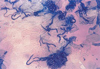 A positive cellophane tape preparation of tinea versicolor that has been stained with methylene blue. The characteristic clusters of spores and short hyphae are demonstrated. (Courtesy of James E. Fitzpatrick, MD.)