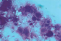 A positive Tzanck preparation demonstrating large multinucleated keratinocytes. The nuclei of normal keratinocytes are the size of neutrophils, which are the other cells present in this preparation. (Courtesy of James E. Fitzpatrick, MD.)