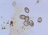 A positive scraping for scabies showing an immature mite, eggs, and numerous fecal pellets. (Courtesy of James E. Fitzpatrick, MD.)