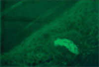 Direct immunofluorescent study demonstrating granular deposits of IgA within a blood vessel of a patient with Henoch- Schönlein purpura. (Courtesy of James E. Fitzpatrick, MD.)