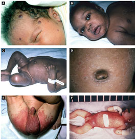 Figure 2.3 A: Dermal hematopoiesis (Courtesy of Dr. Vandana Mehta) B: Congenital syphilis (Courtesy of Dr. Paul Getz) C: Congenital syphilis (Courtesy of Dr. Paul Getz) D: Congenital syphilis (Courtesy of Dr. Paul Getz) E: Candidiasis (Courtesy of Dr. Paul Getz) F: Langerhans cell histiocytosis (Reprint from Morgan MB, Smoller BR, Somach SC. Deadly Dermatologic Diseases. New York, NY: Springer; 2007)